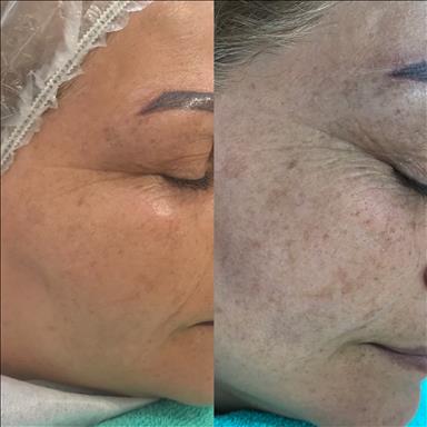 سالن زیبایی آموزش پاکسازی پوست اندواری  در  آمل