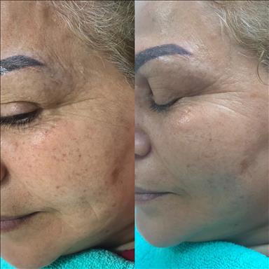 سالن زیبایی آموزش پاکسازی پوست اندواری  در  آمل