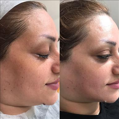 سالن زیبایی آموزش پاکسازی پوست اندواری  در  آمل