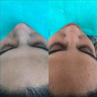 سالن زیبایی آموزش پاکسازی پوست اندواری  در  آمل