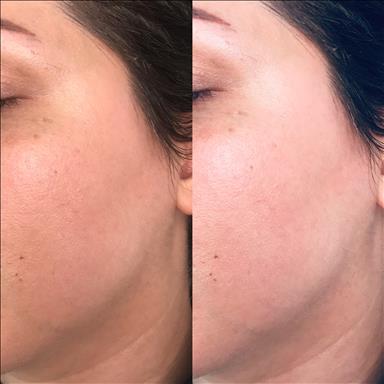 سالن زیبایی آموزش پاکسازی پوست اندواری  در  آمل