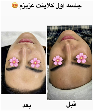 سالن زیبایی پاکسازی و فیشال حسنا  در  بابلسر